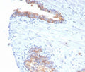IHC staining of FFPE human prostate carcinoma tissue with CD38 antibody (clone rCD38/6982) at 2ug/ml. HIER: boil tissue sections in pH 9 10mM Tris with 1mM EDTA for 20 min and allow to cool before testing.