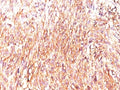IHC: Formalin-fixed, paraffin-embedded human GIST stained with DOG1 antibody (clone DOG1.1).