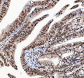 IHC staining of FFPE human rectum adenocarcinoma tissue with ILF2 antibody. HIER: boil tissue sections in pH8 EDTA for 20 min and allow to cool before testing.