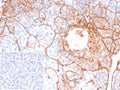 IHC staining of FFPE human pancreas tissue with COL4A5 antibody (clone COL4A5/9396R). Inset: PBS used in place of primary Ab (secondary Ab negative control). HIER: boil tissue sections in pH 9 10mM Tris with 1mM EDTA for 20 min and allow to cool before testing.