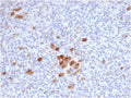 IHC staining of FFPE human Hodgkins lymphoma tissue with recombinant CD30 antibody (clone rKi-1/6913) at 2ug/ml in PBS for 30min RT. Staining of Reed-Sternberg cells is observed. HIER: boil tissue sections in pH 9 10mM Tris with 1mM EDTA for 20 min and allow to cool before testing.