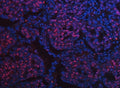 Immunofluorescent staining of FFPE human lung squamous cell carcinoma tissue with SCML1 antibody (red) and DAPI nuclear stain (blue). HIER: steam section in pH8 EDTA buffer for 20 min.