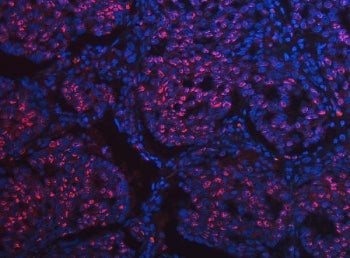 Immunofluorescent staining of FFPE human lung squamous cell carcinoma tissue with SCML1 antibody (red) and DAPI nuclear stain (blue). HIER: steam section in pH8 EDTA buffer for 20 min.
