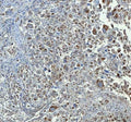IHC staining of FFPE human lung adenocarcinoma tissue with CHGA antibody. HIER: boil tissue sections in pH8 EDTA for 20 min and allow to cool before testing.