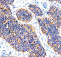 Immunohistochemical staining of CYP2W1 using anti-CYP2W1 antibody. CYP2W1 was detected in a paraffin-embedded section of human ovarian cancer tissue. Heat mediated antigen retrieval was performed in EDTA buffer (pH 8.0, epitope retrieval solution). The tissue section was blocked with 10% goat serum. The tissue section was then incubated with 2 ug/ml rabbit anti-CYP2W1 antibody overnight at 4oC. Peroxidase Conjugated Goat Anti-rabbit IgG was used as secondary antibody and incubated for 30 min at 37oC.
