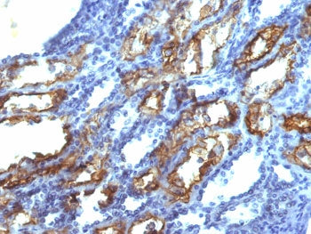 IHC testing of FFPE human renal cell carcinoma with IFN gamma antibody (clone IFNG/466). Required HIER: boil tissue sections in 10mM Tris with 1mM EDTA, pH 9.0, for 10-20 min.