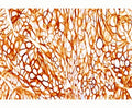 IHC testing of FFPE human colon cancer stained with Cytokeratin 18 antibody (clone DA7).