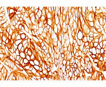 IHC testing of FFPE human colon cancer stained with Cytokeratin 18 antibody (clone DA7).