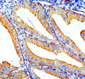 Immunohistochemical staining of ZIP8/SLC39A8 using anti-SLC39A8 antibody. ZIP8/SLC39A8 was detected in a paraffin-embedded section of human endometrial cancer tissue. Heat mediated antigen retrieval was performed in EDTA buffer (pH 8.0, epitope retrieval solution). The tissue section was blocked with 10% goat serum. The tissue section was then incubated with 2 ug/ml rabbit anti-SLC39A8 antibody overnight at 4oC.