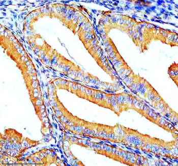 Immunohistochemical staining of ZIP8/SLC39A8 using anti-SLC39A8 antibody. ZIP8/SLC39A8 was detected in a paraffin-embedded section of human endometrial cancer tissue. Heat mediated antigen retrieval was performed in EDTA buffer (pH 8.0, epitope retrieval solution). The tissue section was blocked with 10% goat serum. The tissue section was then incubated with 2 ug/ml rabbit anti-SLC39A8 antibody overnight at 4oC.
