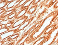 IHC testing of FFPE human renal cell carcinoma with Calnexin antibody (clone CLNXN-1). HIER: boil tissue sections in pH 9 10mM Tris with 1mM EDTA for 10-20 min followed by cooling at RT for 20 min.