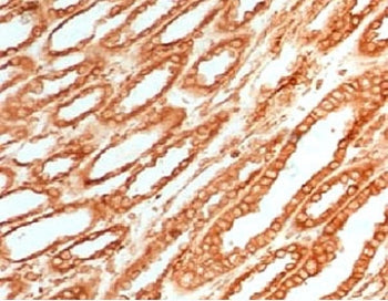 IHC testing of FFPE human renal cell carcinoma with Calnexin antibody (clone CLNXN-1). HIER: boil tissue sections in pH 9 10mM Tris with 1mM EDTA for 10-20 min followed by cooling at RT for 20 min.