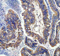 IHC staining of FFPE human colon cancer tissue with NDUFS1 antibody, HRP-secondary and DAB substrate. HIER: boil tissue sections in pH8 EDTA for 20 min and allow to cool before testing.