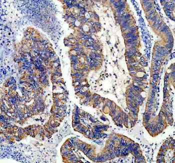 IHC staining of FFPE human colon cancer tissue with NDUFS1 antibody, HRP-secondary and DAB substrate. HIER: boil tissue sections in pH8 EDTA for 20 min and allow to cool before testing.