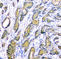 IHC staining of FFPE human prostate cancer tissue with c-Kit antibody. HIER: boil tissue sections in pH8 EDTA for 20 min and allow to cool before testing.