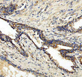 IHC analysis of CLCN3 using anti-CLCN3 antibody. CLCN3 was detected in a paraffin-embedded section of human prostatic cancer tissue. Heat mediated antigen retrieval was performed in EDTA buffer (pH 8.0, epitope retrieval solution). The tissue section was blocked with 10% goat serum. The tissue section was then incubated with 2 ug/ml rabbit anti-CLCN3 antibody overnight at 4oC. Peroxidase Conjugated Goat Anti-rabbit IgG was used as secondary antibody and incubated for 30 min at 37oC.