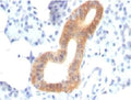 IHC: Formalin-fixed, paraffin-embedded human melanoma stained with CD86 antibody (clone SPM600).