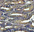 IHC analysis of PIWIL3 using anti-PIWIL3 antibody. PIWIL3 was detected in a paraffin-embedded section of human colon cancer tissue. Heat mediated antigen retrieval was performed in EDTA buffer (pH 8.0, epitope retrieval solution). The tissue section was blocked with 10% goat serum. The tissue section was then incubated with 2 ug/ml rabbit anti-PIWIL3 antibody overnight at 4oC. Peroxidase Conjugated Goat Anti-rabbit IgG was used as secondary antibody and incubated for 30 min at 37oC.