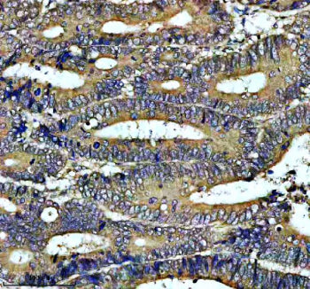 IHC analysis of PIWIL3 using anti-PIWIL3 antibody. PIWIL3 was detected in a paraffin-embedded section of human colon cancer tissue. Heat mediated antigen retrieval was performed in EDTA buffer (pH 8.0, epitope retrieval solution). The tissue section was blocked with 10% goat serum. The tissue section was then incubated with 2 ug/ml rabbit anti-PIWIL3 antibody overnight at 4oC. Peroxidase Conjugated Goat Anti-rabbit IgG was used as secondary antibody and incubated for 30 min at 37oC.