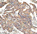 IHC analysis of NEK9 using anti-NEK9 antibody. NEK9 was detected in a paraffin-embedded section of human breast cancer tissue. Heat mediated antigen retrieval was performed in EDTA buffer (pH 8.0, epitope retrieval solution). The tissue section was blocked with 10% goat serum. The tissue section was then incubated with 2 ug/ml rabbit anti-NEK9 antibody overnight at 4oC. Peroxidase Conjugated Goat Anti-rabbit IgG was used as secondary antibody and incubated for 30 min at 37oC.