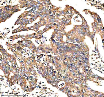 IHC analysis of NEK9 using anti-NEK9 antibody. NEK9 was detected in a paraffin-embedded section of human breast cancer tissue. Heat mediated antigen retrieval was performed in EDTA buffer (pH 8.0, epitope retrieval solution). The tissue section was blocked with 10% goat serum. The tissue section was then incubated with 2 ug/ml rabbit anti-NEK9 antibody overnight at 4oC. Peroxidase Conjugated Goat Anti-rabbit IgG was used as secondary antibody and incubated for 30 min at 37oC.