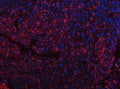 Immunofluorescent staining of FFPE human esophageal squamous carcinoma with Tip110 antibody (red) and DAPI nuclear stain (blue). HIER: steam section in pH8 EDTA buffer for 20 min.
