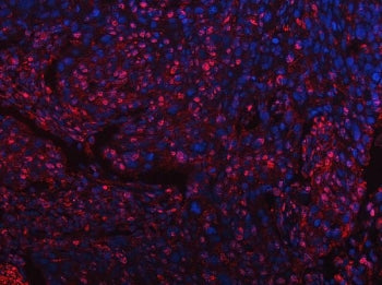Immunofluorescent staining of FFPE human esophageal squamous carcinoma with Tip110 antibody (red) and DAPI nuclear stain (blue). HIER: steam section in pH8 EDTA buffer for 20 min.