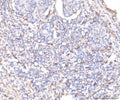 IHC staining of FFPE human lung cancer tissue with KCNQ1 antibody. HIER: boil tissue sections in pH8 EDTA for 20 min and allow to cool before testing.