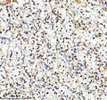 Immunohistochemical staining of PIF1 using anti-PIF1 antibody. PIF1 was detected in a paraffin-embedded section of human renal cancer tissue. Heat mediated antigen retrieval was performed in EDTA buffer (pH 8.0, epitope retrieval solution). The tissue section was blocked with 10% goat serum. The tissue section was then incubated with 2 ug/ml rabbit anti-PIF1 antibody overnight at 4oC. Peroxidase Conjugated Goat Anti-rabbit IgG was used as secondary antibody and incubated for 30 min at 37oC.