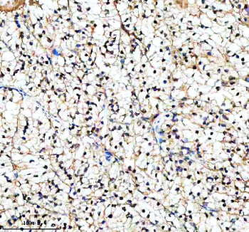 Immunohistochemical staining of PIF1 using anti-PIF1 antibody. PIF1 was detected in a paraffin-embedded section of human renal cancer tissue. Heat mediated antigen retrieval was performed in EDTA buffer (pH 8.0, epitope retrieval solution). The tissue section was blocked with 10% goat serum. The tissue section was then incubated with 2 ug/ml rabbit anti-PIF1 antibody overnight at 4oC. Peroxidase Conjugated Goat Anti-rabbit IgG was used as secondary antibody and incubated for 30 min at 37oC.