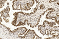 IHC testing of FFPE human ovarian cancer tissue with PCNA antibody. HIER: steam section in pH6 citrate buffer for 20 min and allow to cool prior to staining.