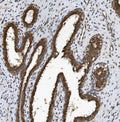IHC staining of FFPE human breast cancer with BCRP antibody. HIER: boil tissue sections in pH8 EDTA for 20 min and allow to cool before testing.