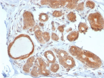 IHC staining of FFPE human breast carcinoma with STAT5b antibody. HIER: boil tissue sections in pH 9 10mM Tris with 1mM EDTA for 20 min and allow to cool before testing.