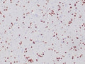 IHC staining of FFPE human oligodendroglioma tissue with recombinant OLIG2 antibody (clone OLIG2/6695R). HIER: boil tissue sections in pH 9 10mM Tris with 1mM EDTA for 20 min and allow to cool before testing.