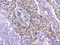IHC testing of FFPE human lung cancer with TCP1 alpha antibody at 2ug/ml. HIER: boil tissue sections in pH6, 10mM citrate buffer, for 10-20 min followed by cooling at RT for 20 min.
