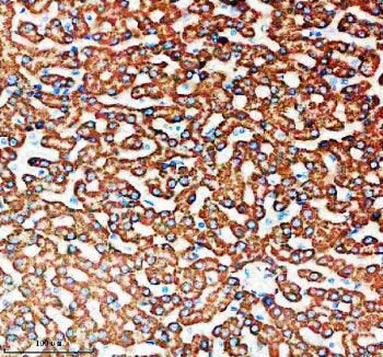 Immunohistochemical staining of SNX16 using anti-SNX16 antibody. SNX16 was detected in a paraffin-embedded section of human liver tissue. Heat mediated antigen retrieval was performed in EDTA buffer (pH 8.0, epitope retrieval solution). The tissue section was blocked with 10% goat serum. The tissue section was then incubated with 2 ug/ml rabbit anti-SNX16 antibody overnight at 4oC. Peroxidase Conjugated Goat Anti-rabbit IgG was used as secondary antibody and incubated for 30 min at 37oC.