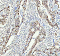 Immunohistochemical staining of FAM50A using anti-FAM50A antibody. FAM50A was detected in a paraffin-embedded section of human thyroid cancer tissue. Heat mediated antigen retrieval was performed in EDTA buffer (pH 8.0, epitope retrieval solution). The tissue section was blocked with 10% goat serum. The tissue section was then incubated with 1:50 rabbit anti-FAM50A antibody overnight at 4oC. Peroxidase Conjugated Goat Anti-rabbit IgG was used as secondary antibody and incubated for 30 min at 37oC.