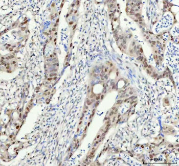Immunohistochemical staining of FAM50A using anti-FAM50A antibody. FAM50A was detected in a paraffin-embedded section of human thyroid cancer tissue. Heat mediated antigen retrieval was performed in EDTA buffer (pH 8.0, epitope retrieval solution). The tissue section was blocked with 10% goat serum. The tissue section was then incubated with 1:50 rabbit anti-FAM50A antibody overnight at 4oC. Peroxidase Conjugated Goat Anti-rabbit IgG was used as secondary antibody and incubated for 30 min at 37oC.