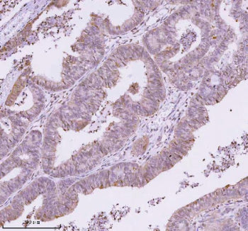 IHC analysis of RBBP8 using anti-RBBP8 antibody. RBBP8 was detected in a paraffin-embedded section of human endometrioid adenocarcinoma tissue. Heat mediated antigen retrieval was performed in EDTA buffer (pH 8.0, epitope retrieval solution). The tissue section was blocked with 10% goat serum. The tissue section was then incubated with 2 ug/ml rabbit anti-RBBP8 antibody overnight at 4oC. Peroxidase Conjugated Goat Anti-rabbit IgG was used as secondary antibody and incubated for 30 min at 37oC.