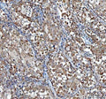 IHC staining of FFPE human lung cancer tissue with TCP1 alpha antibody. HIER: boil tissue sections in pH8 EDTA for 20 min and allow to cool before testing.
