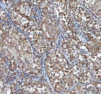 IHC staining of FFPE human lung cancer tissue with TCP1 alpha antibody. HIER: boil tissue sections in pH8 EDTA for 20 min and allow to cool before testing.