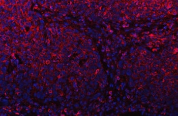 Immunofluorescent staining of FFPE human esophagus squama cancer tissue with PLD6 antibody (red) and DAPI nuclear stain (blue). HIER: steam section in pH6 citrate buffer for 20 min.