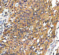 Immunohistochemical staining of GPD1 using anti-GPD1 antibody. GPD1 was detected in a paraffin-embedded section of human bladder cancer tissue. Heat mediated antigen retrieval was performed in EDTA buffer (pH 8.0, epitope retrieval solution). The tissue section was blocked with 10% goat serum. The tissue section was then incubated with 2 ug/ml rabbit anti-GPD1 antibody overnight at 4oC. Peroxidase Conjugated Goat Anti-rabbit IgG was used as secondary antibody and incubated for 30 min at 37oC.