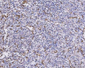 IHC staining of FFPE human glioma tissue with CXCL1 antibody. HIER: boil tissue sections in pH8 EDTA for 20 min and allow to cool before testing.
