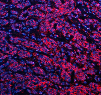Immunofluorescent staining of GSTK1 using anti-GSTK1 antibody (red). GSTK1 was detected in a paraffin-embedded section of human breast cancer tissue. Heat mediated antigen retrieval was performed in EDTA buffer (pH 8.0, epitope retrieval solution). The tissue section was blocked with 10% goat serum. The tissue section was then incubated with 5 ug/ml rabbit anti-GSTK1 antibody overnight at 4oC.