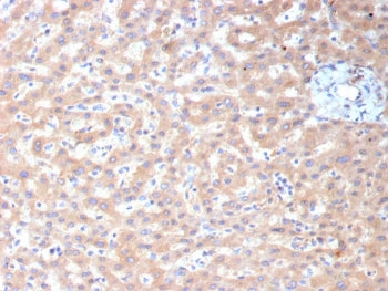 IHC staining of FFPE human hepatocellular carcinoma tissue with ADH1L1 antibody (clone ALDH1L1/7959). HIER: boil tissue sections in pH 9 10mM Tris with 1mM EDTA for 20 min and allow to cool before testing.
