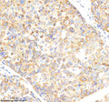 Immunohistochemical staining of NCLN using anti-NCLN antibody. NCLN was detected in a paraffin-embedded section of human liver cancer tissue. Heat mediated antigen retrieval was performed in EDTA buffer (pH 8.0, epitope retrieval solution). The tissue section was blocked with 10% goat serum. The tissue section was then incubated with 2 ug/ml rabbit anti-NCLN antibody overnight at 4oC. Peroxidase Conjugated Goat Anti-rabbit IgG was used as secondary antibody and incubated for 30 min at 37oC.