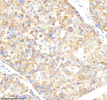 Immunohistochemical staining of NCLN using anti-NCLN antibody. NCLN was detected in a paraffin-embedded section of human liver cancer tissue. Heat mediated antigen retrieval was performed in EDTA buffer (pH 8.0, epitope retrieval solution). The tissue section was blocked with 10% goat serum. The tissue section was then incubated with 2 ug/ml rabbit anti-NCLN antibody overnight at 4oC. Peroxidase Conjugated Goat Anti-rabbit IgG was used as secondary antibody and incubated for 30 min at 37oC.
