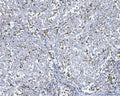 IHC staining of FFPE human lung cancer tissue with CD14 antibody. HIER: boil tissue sections in pH8 EDTA for 20 min and allow to cool before testing.