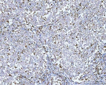 IHC staining of FFPE human lung cancer tissue with CD14 antibody. HIER: boil tissue sections in pH8 EDTA for 20 min and allow to cool before testing.